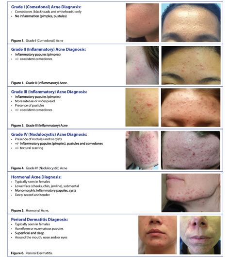 Acne: Diagnosis and treatment .